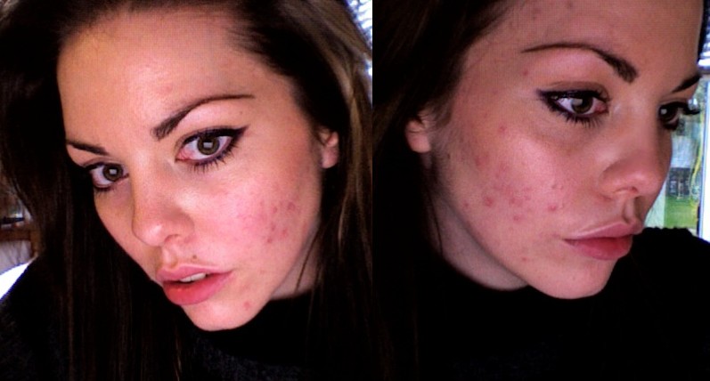 last does red accutane long face how after