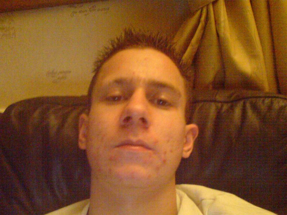 Mike and the battle against acne