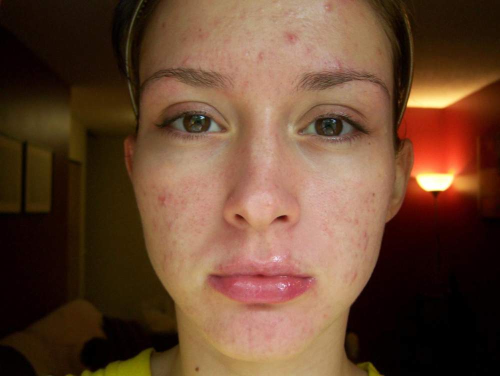 Week for a accutane didnt take