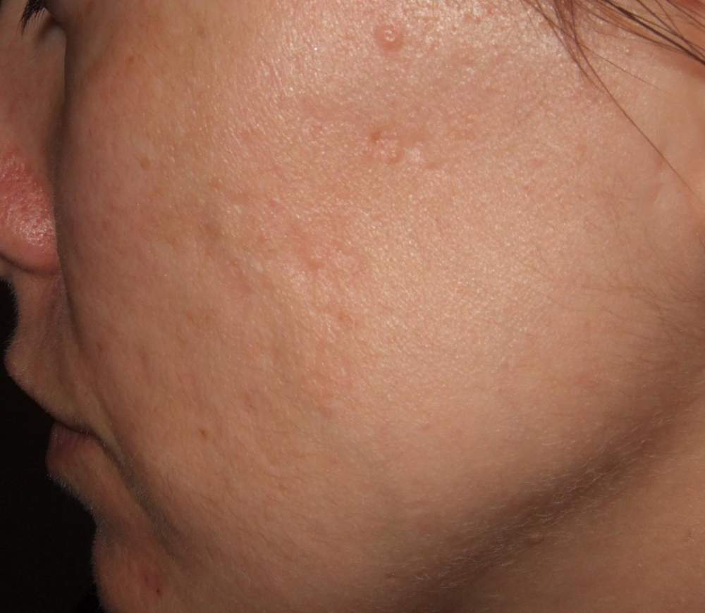 *BEFORE* Fraxel....