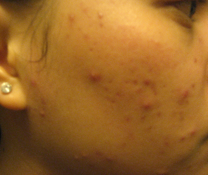 Witch Hazel Worked for ME!