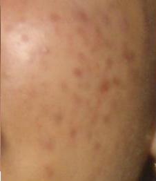 accutane log
