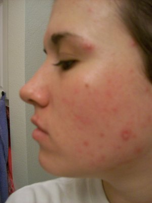 Working with Accutane