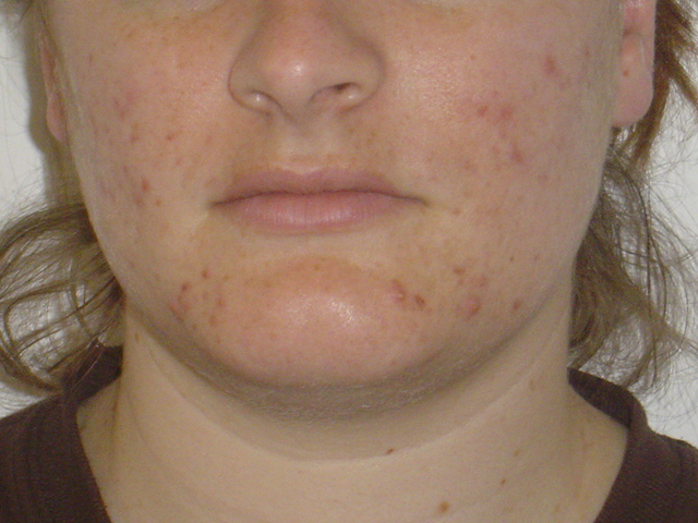 Accutane Journey
