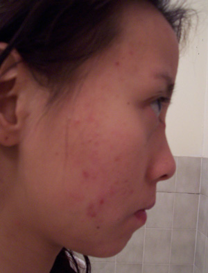 Roaccutane-second course-will work or not?