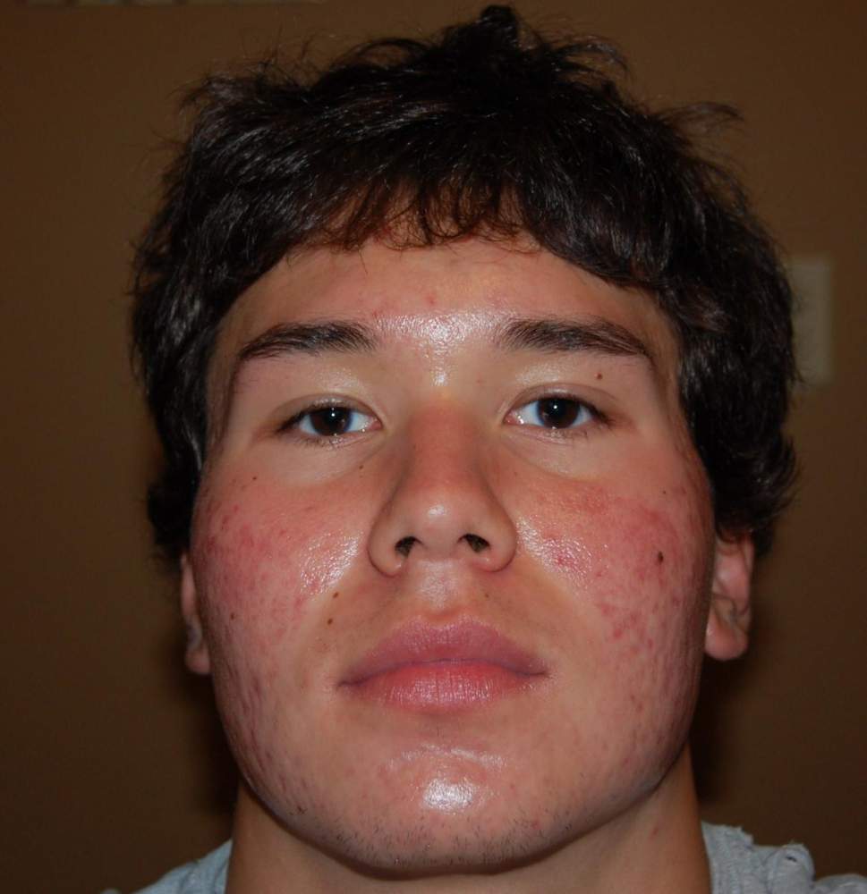 accutane 4th month