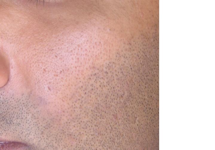 Pitting or large pores?