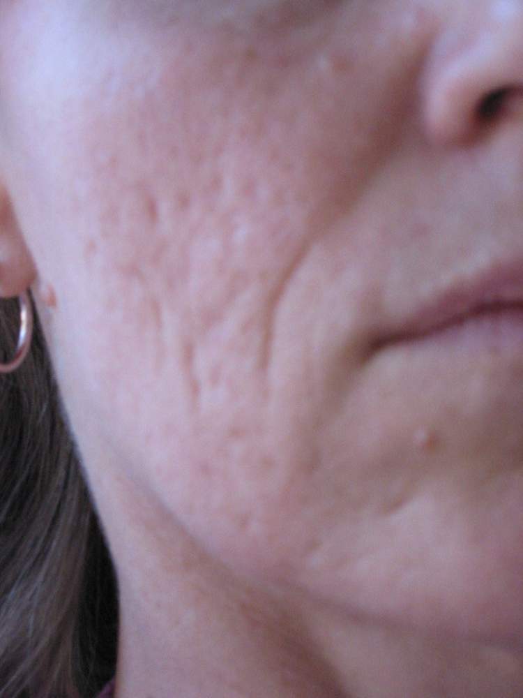 Scar treatment before & after