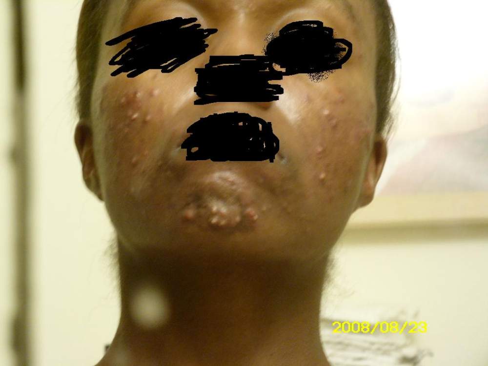 the accutane journey begins