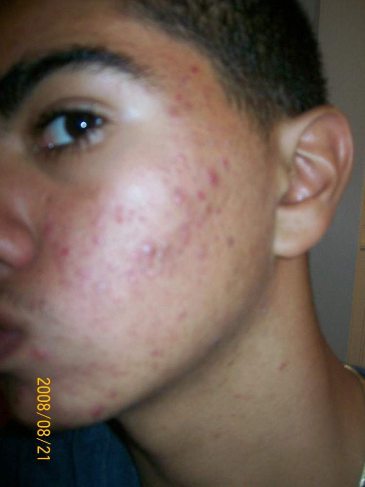 going on accutane