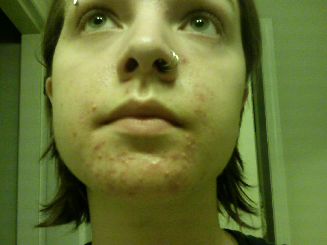 My Journey to Clear Skin