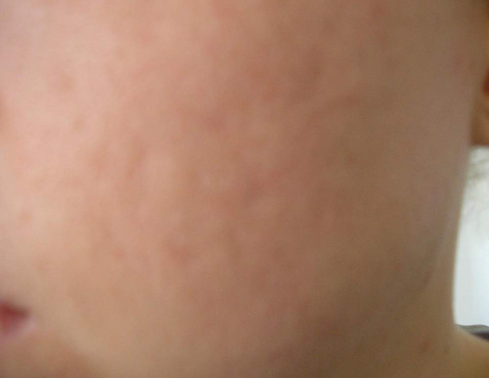 My scar treatments