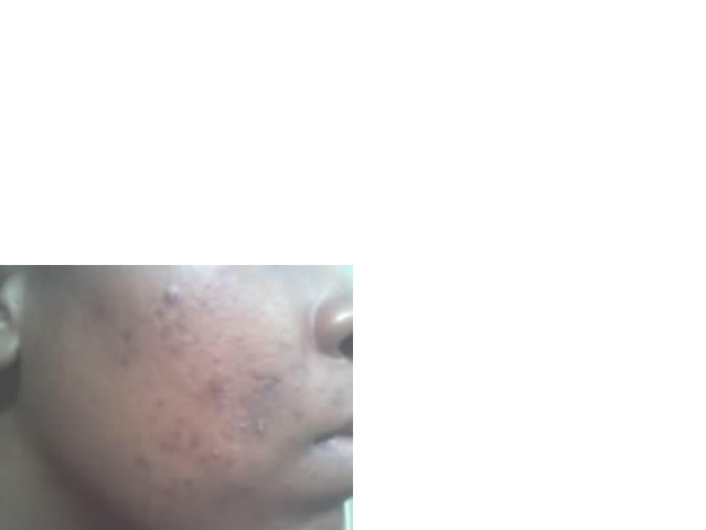 The Beginning of the end (Of Acne)