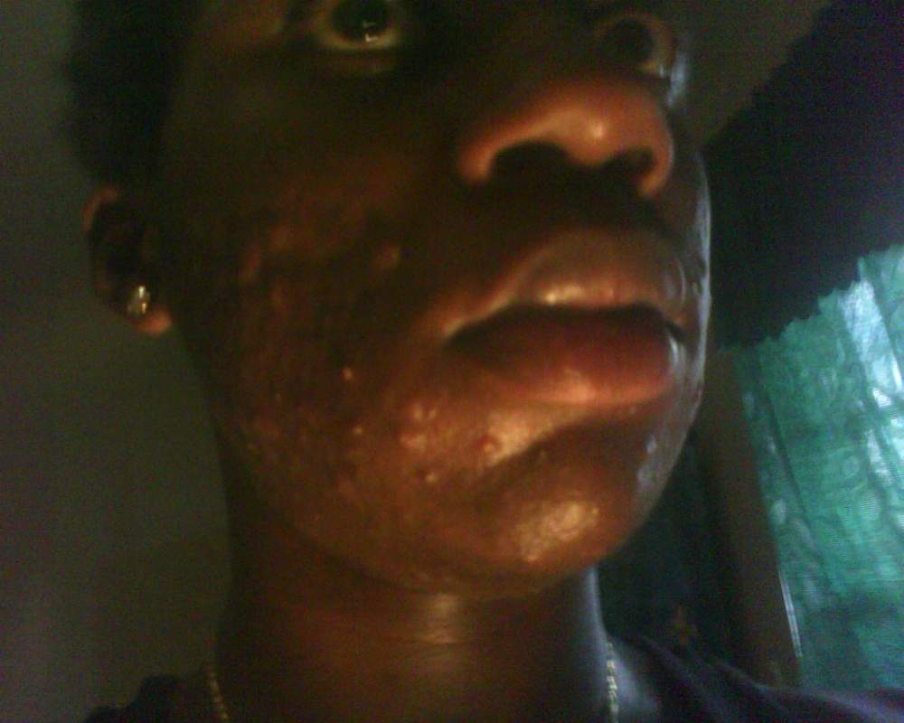 Skeptical about Accutane?! Look Here!!!
