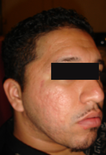 my scars left after severe acne was treated