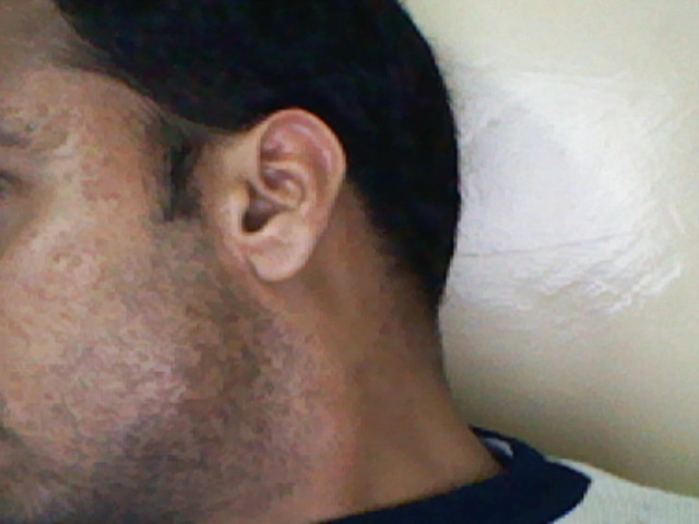 acne after effects