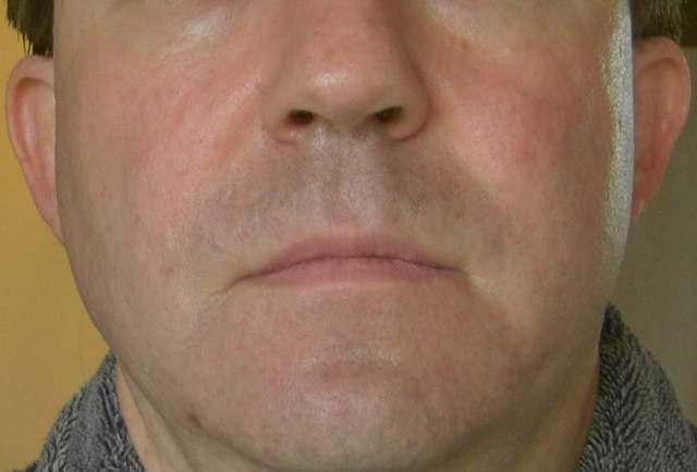 mr. matt's 'Before and After Photos - Subcision and TCA Cross Method