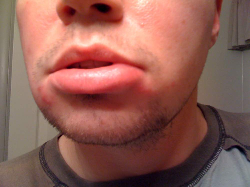 Accutane (isotretinoin) logs Accutane Before, During, After