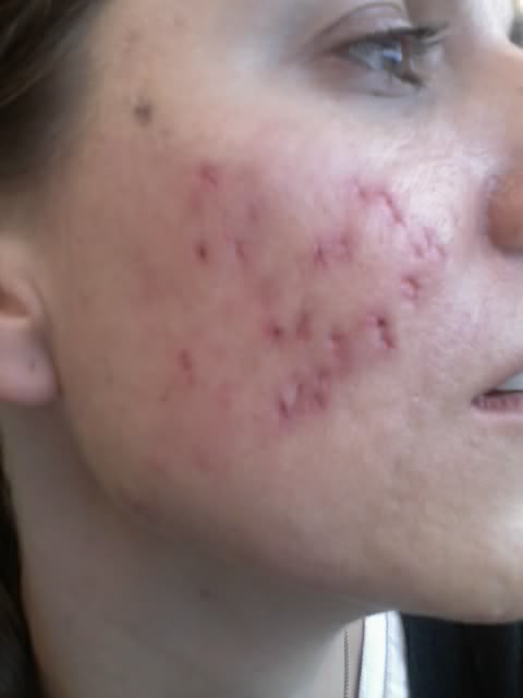 Scar logs - Cystic Acne Scar revision - Right cheek punch excisions