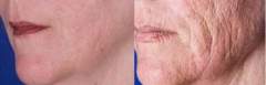 acne scars celebrities