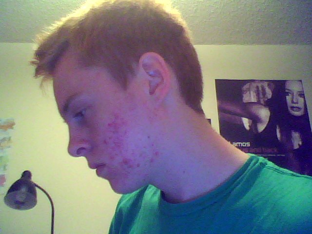 Progress (Accutane)