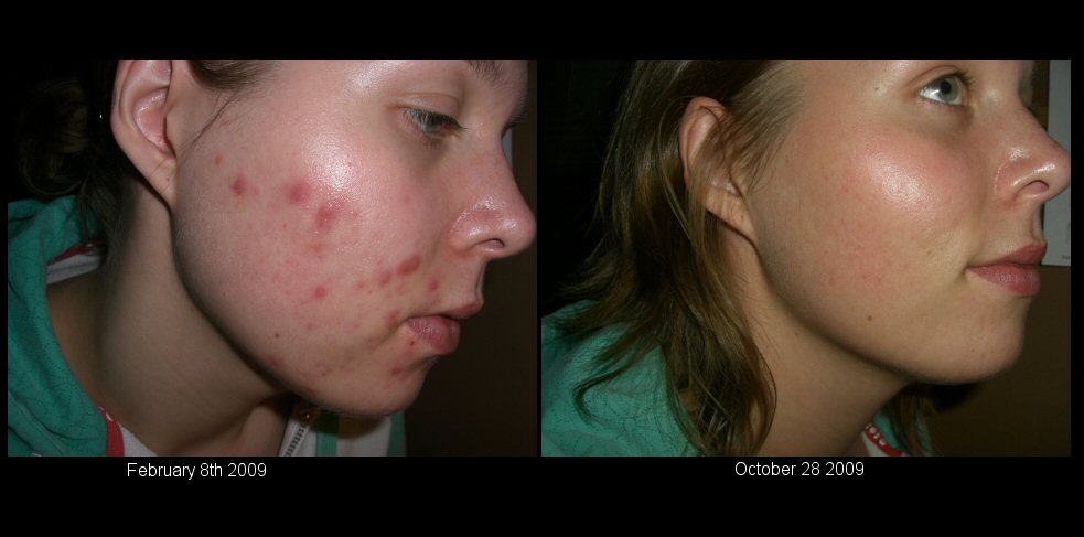 Acne FIXED!