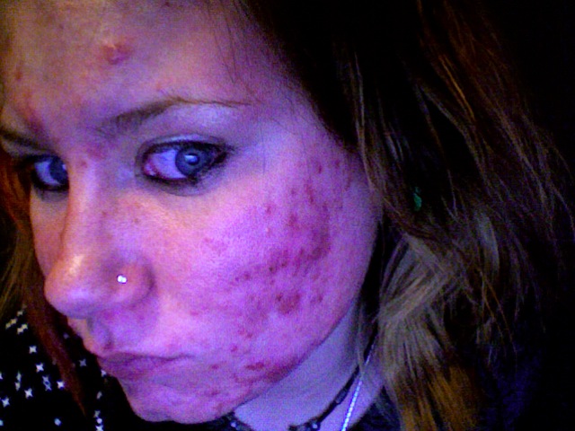 Me on Accutane.