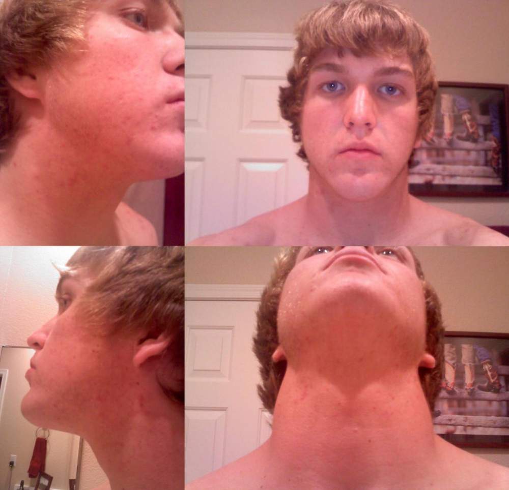 Acne Face/Body Progress