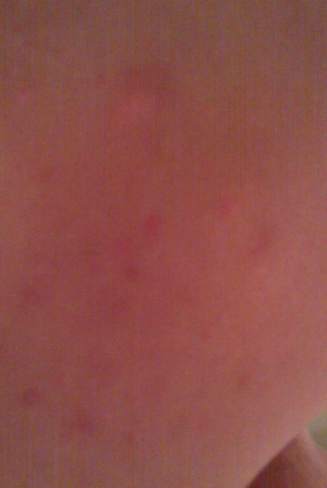 Day 5 of Doxy Regimen