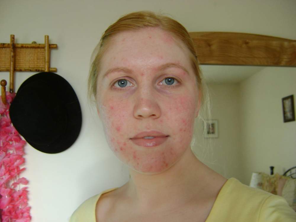 Day One of Differin Cream...my horrible, horrible scarring Day One of Differin Cream...my horrible, horrible scarring