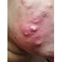 My Journey- I have VERY VERY BAD ACNE.