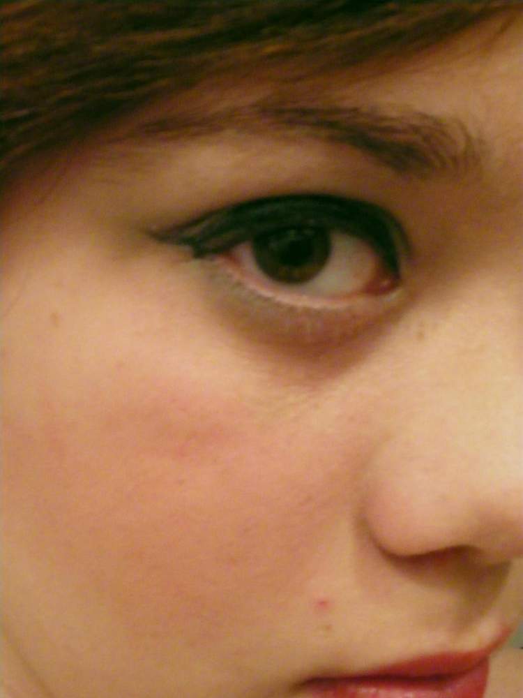 The Rollercoaster That Is...MY SKIN!