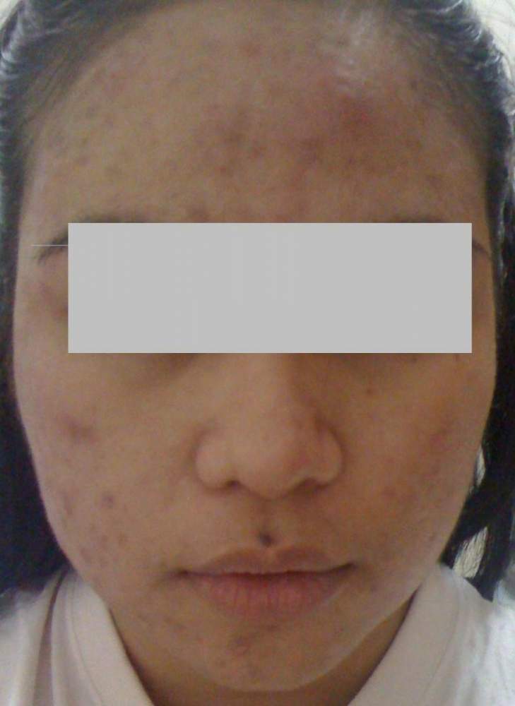 Day 7 into the regimen