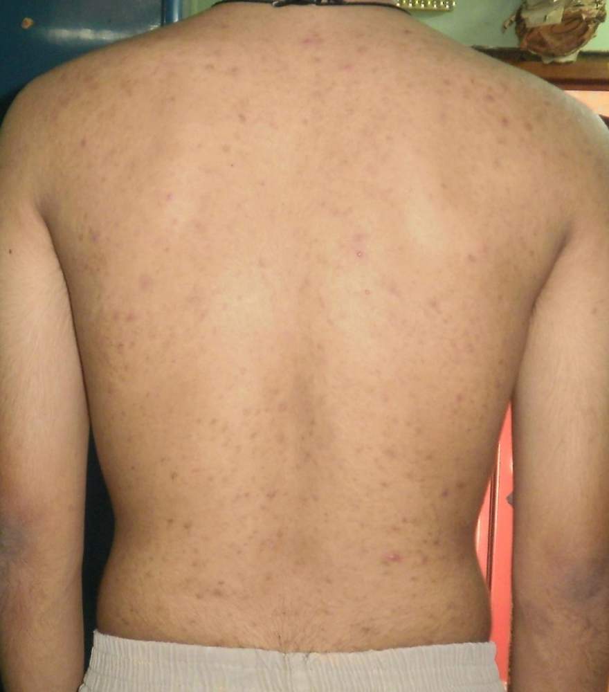 Asho's Body Acne