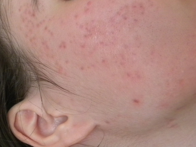 My acne scars/red marks! HEEELP :p