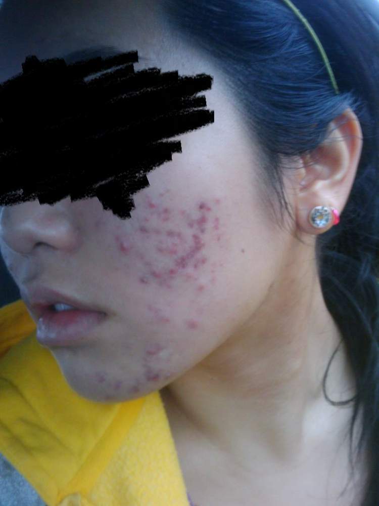 severe scarring on cheeks/chin