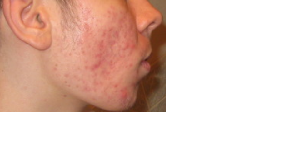 acne2.png
