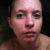 acne-face-nude-teen