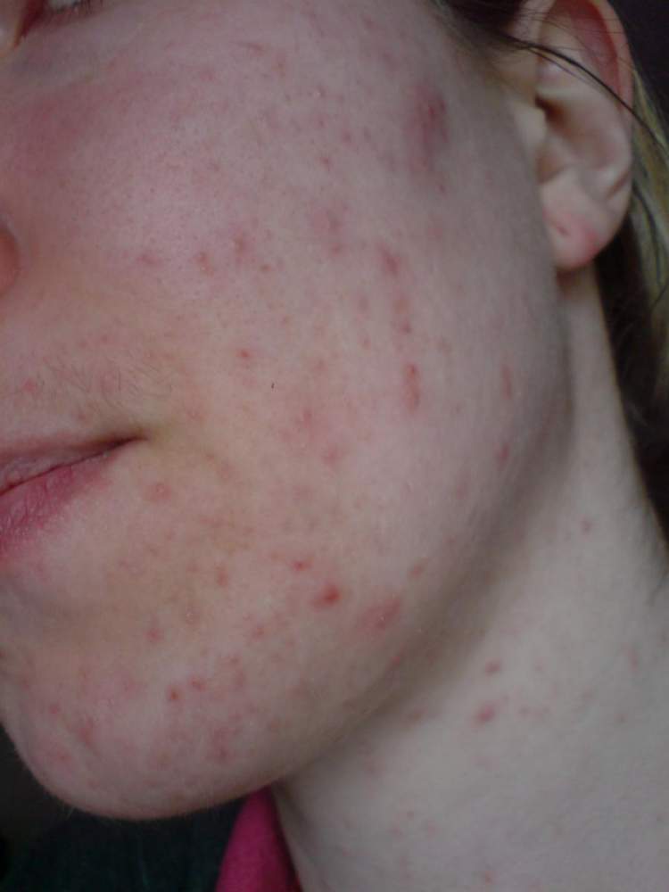 Adult acne at 27