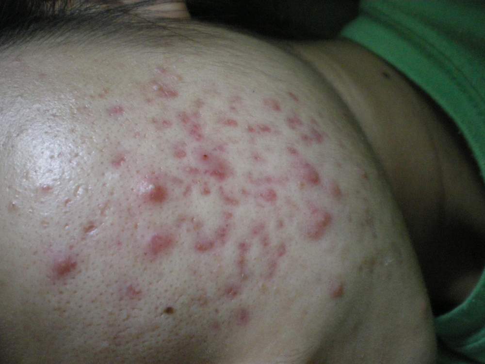 What is the best way to improve my skin?
