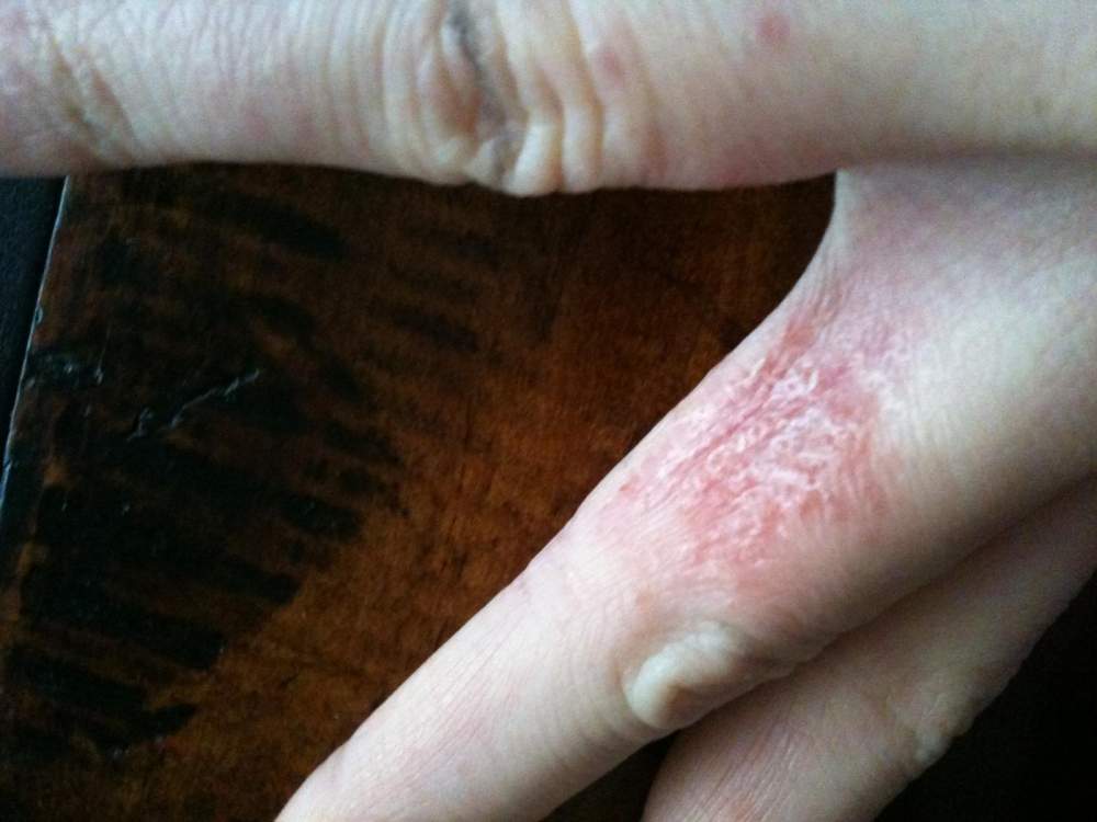 fingers - blistered/ peeling