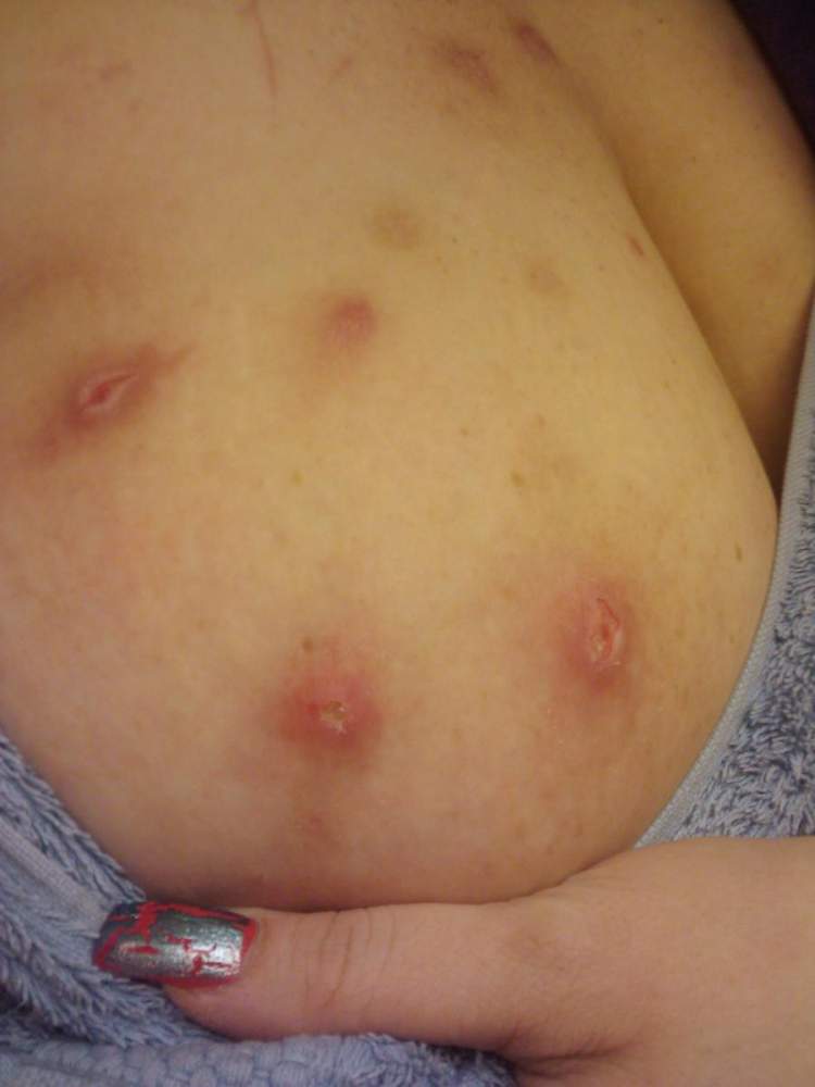 Pic of the open scars I have been picking on my breast