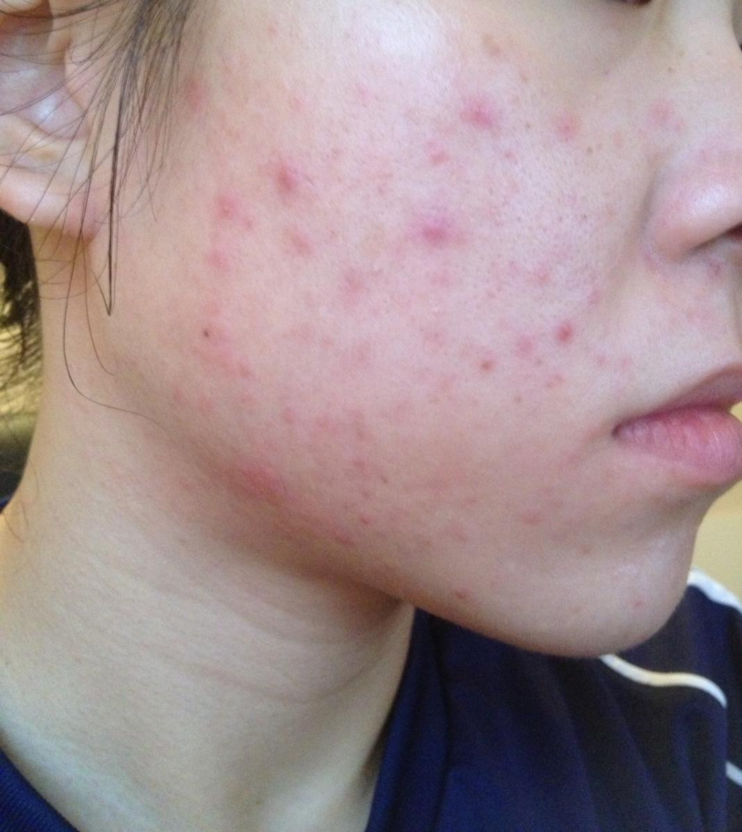 doxycycline acne