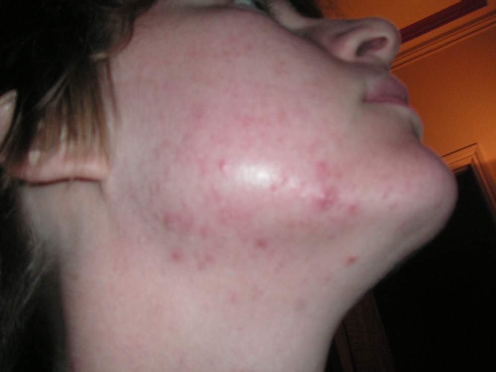 Member pictures - My Acne recovery journey - one menstral month Azelaic