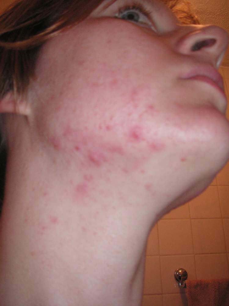 Member pictures - My Acne recovery journey - day 1 june 15th 2010 jaw