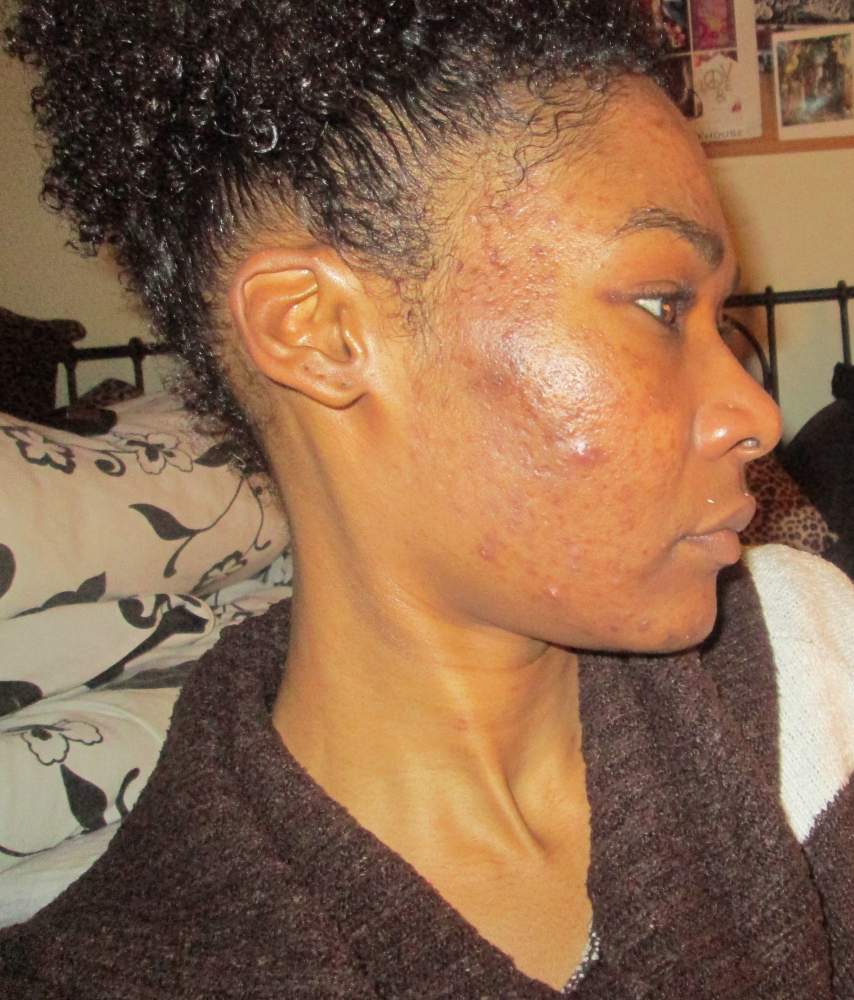 Isotrexin gel on acne scars/hyperpigmentation for darker 