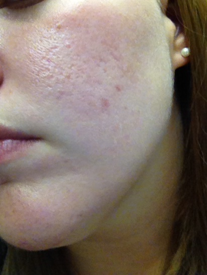 my acne/scars