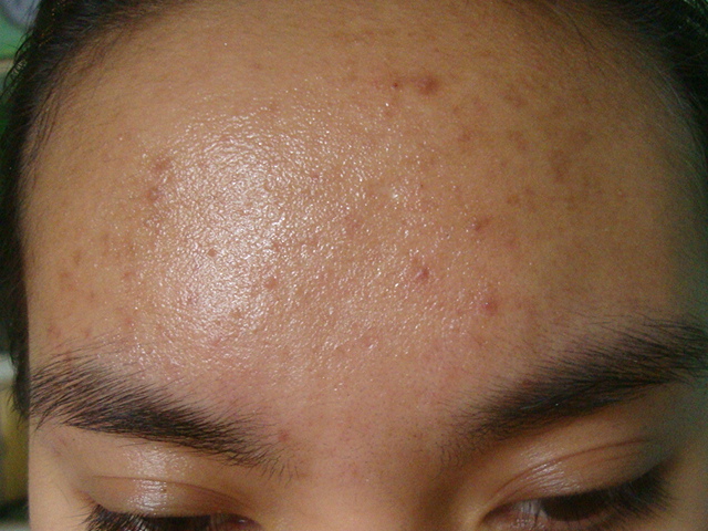 forehead (18th wk)