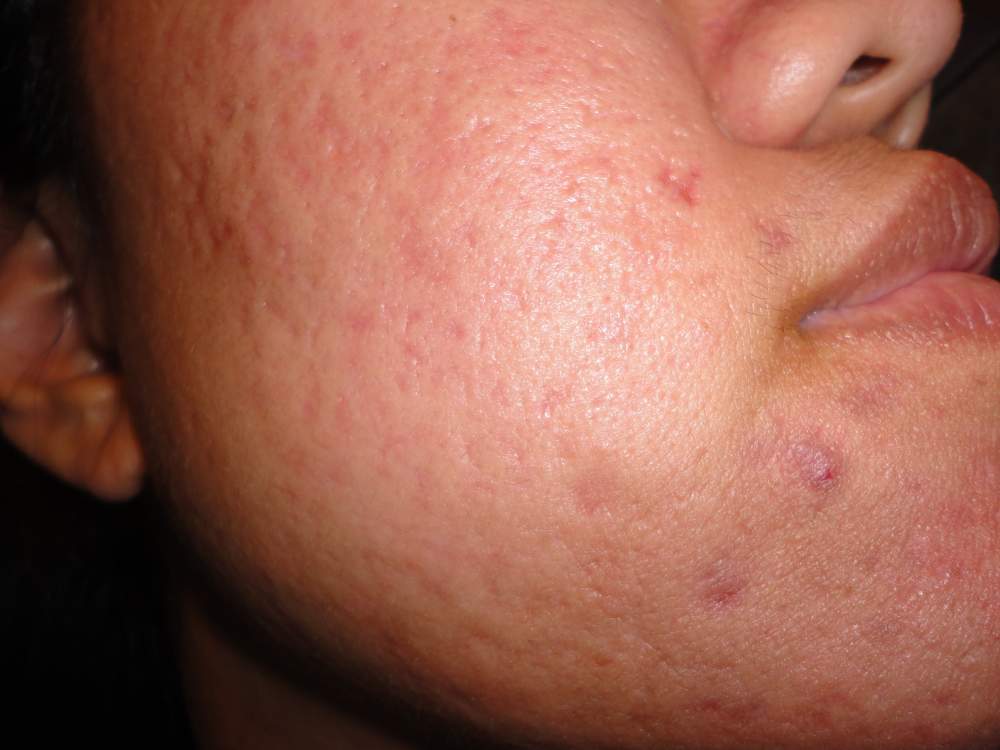 2011-2012 Acne Scars