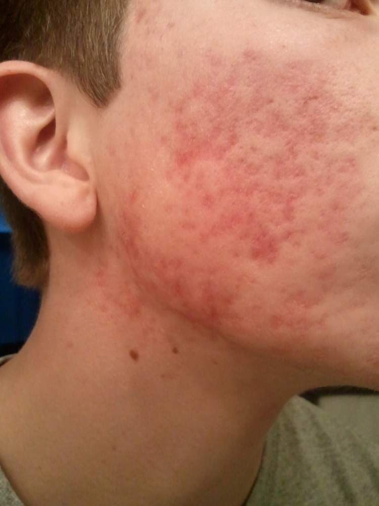 acne-after-accutane